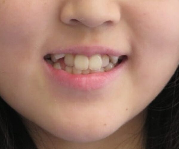 Before - Lusk Orthodontics