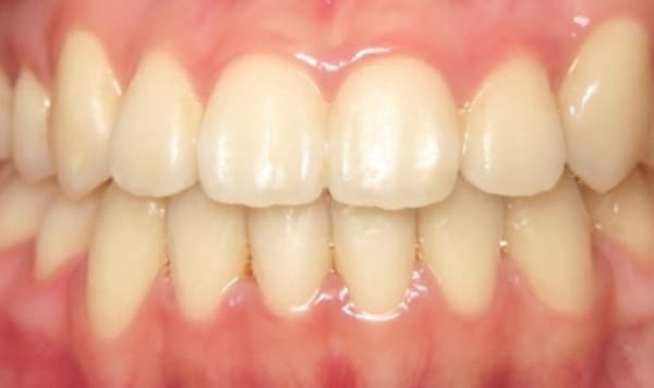 After - Lusk Orthodontics