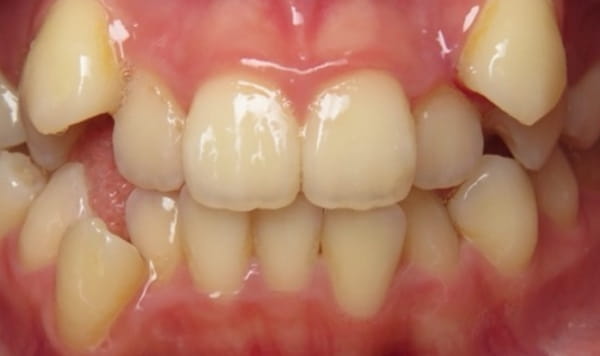 Before - Lusk Orthodontics