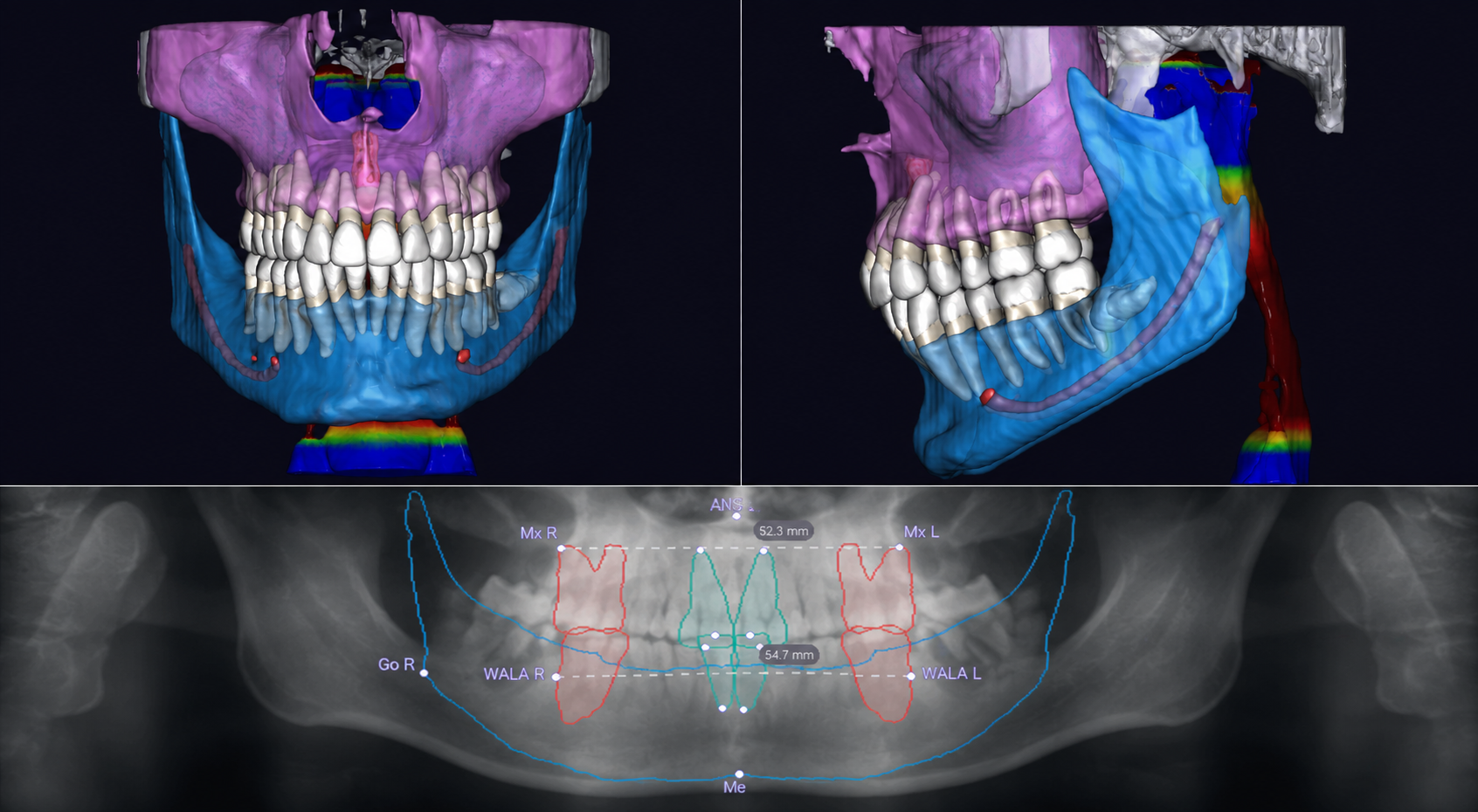 3D digital model of the teeth, jaws and facial structures used for orthodontic diagnosis and treatment planning at Lusk Orthodontics