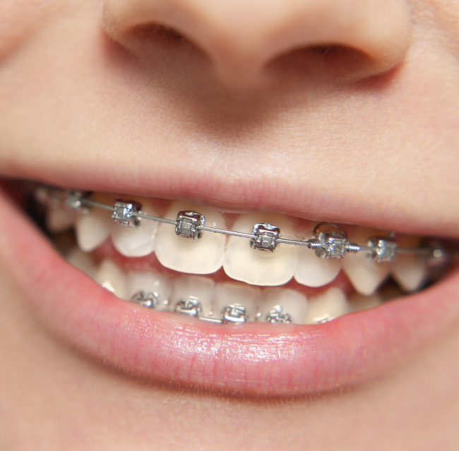 Blog -Lusk Orthodontics